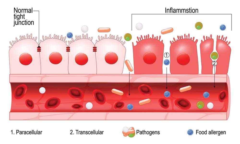 Leaky Gut (permeabilidad intestinal)